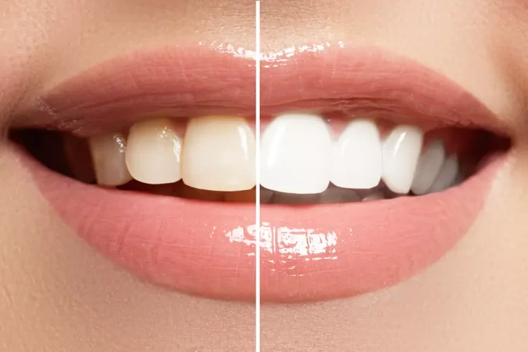 closeup image of teeth whitening before and after